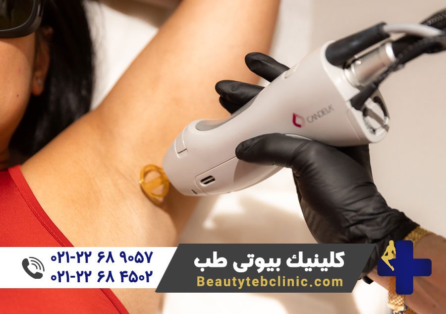 10 مزیت لیزر کندلا جنتل مکس پرو 7 CaTara Med Spa Laser Hair Reduction 0436 1