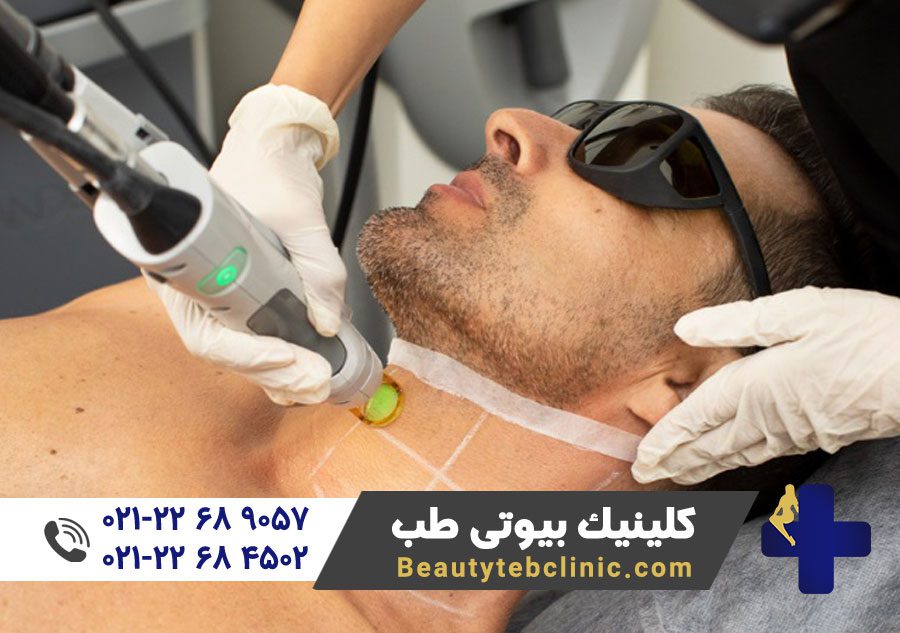 10 مزیت لیزر کندلا جنتل مکس پرو 10 laser clinics candela a tailored laser hair removal for you